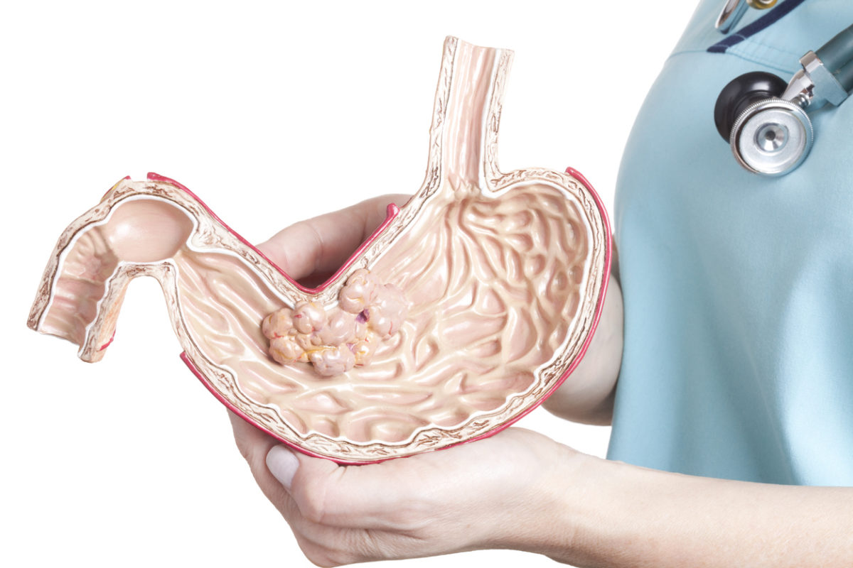 καρκίνος στομάχου