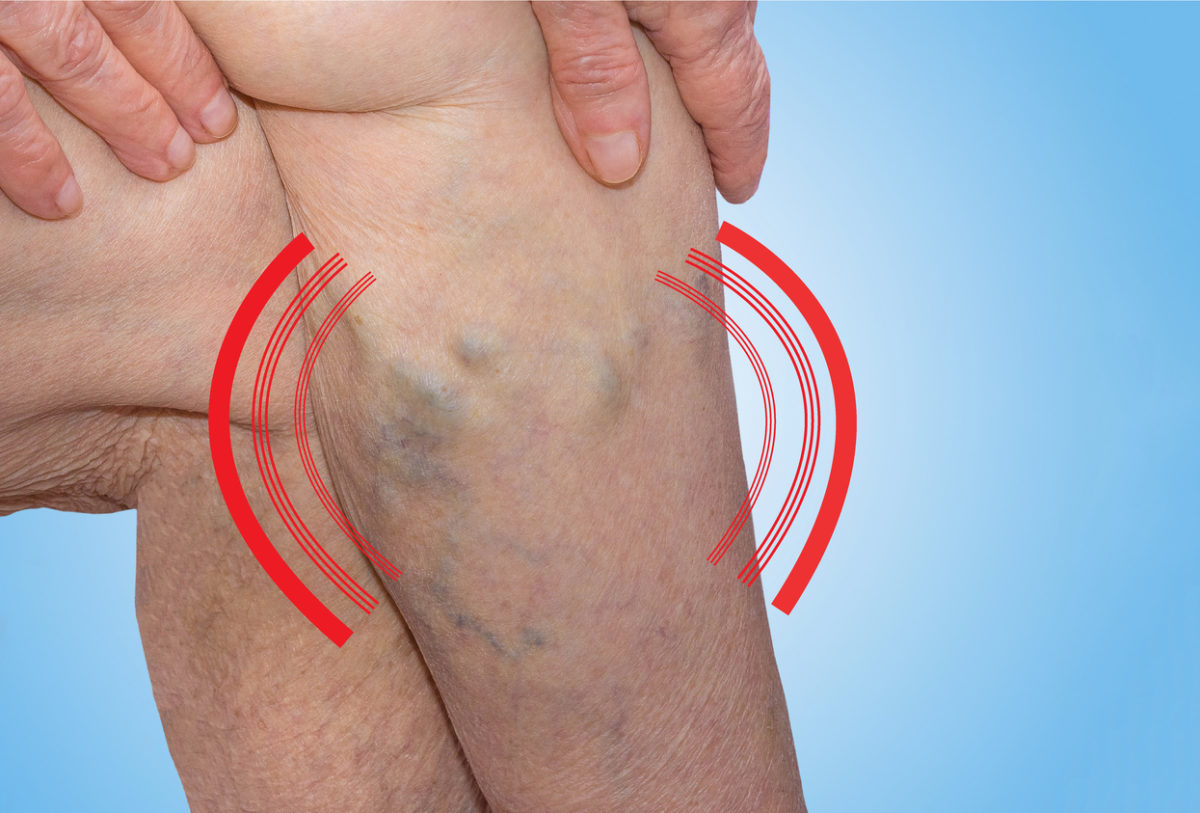 φλεβική θρόμβωση