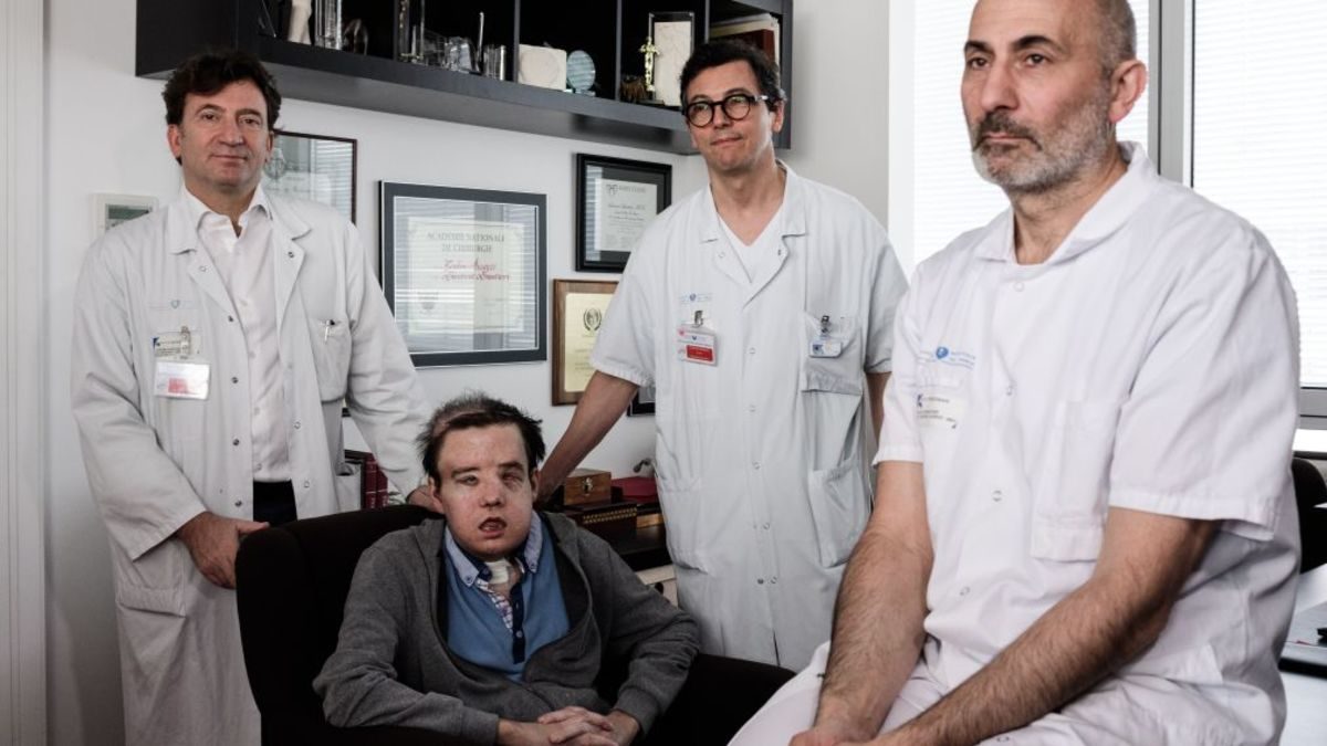 Μεταμόσχευση προσώπου