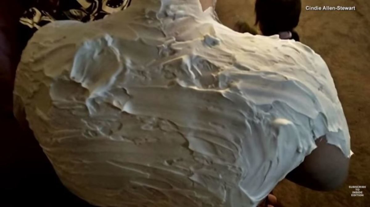 ηλιακό έγκαυμα