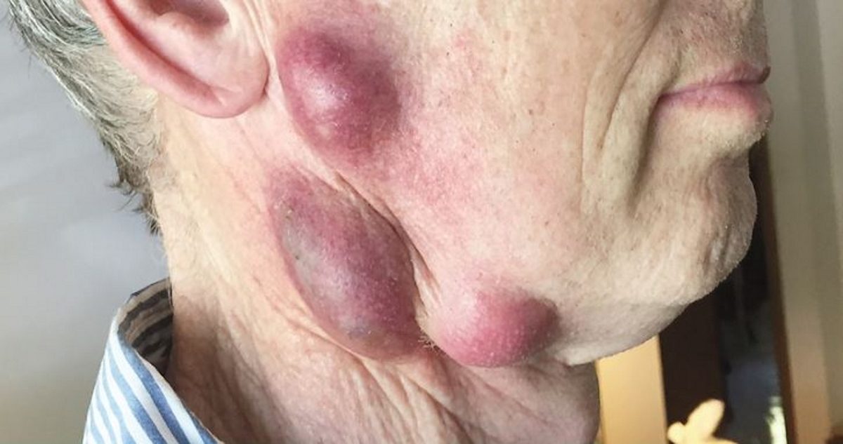 τουλαραιμία