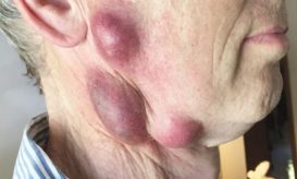 τουλαραιμία