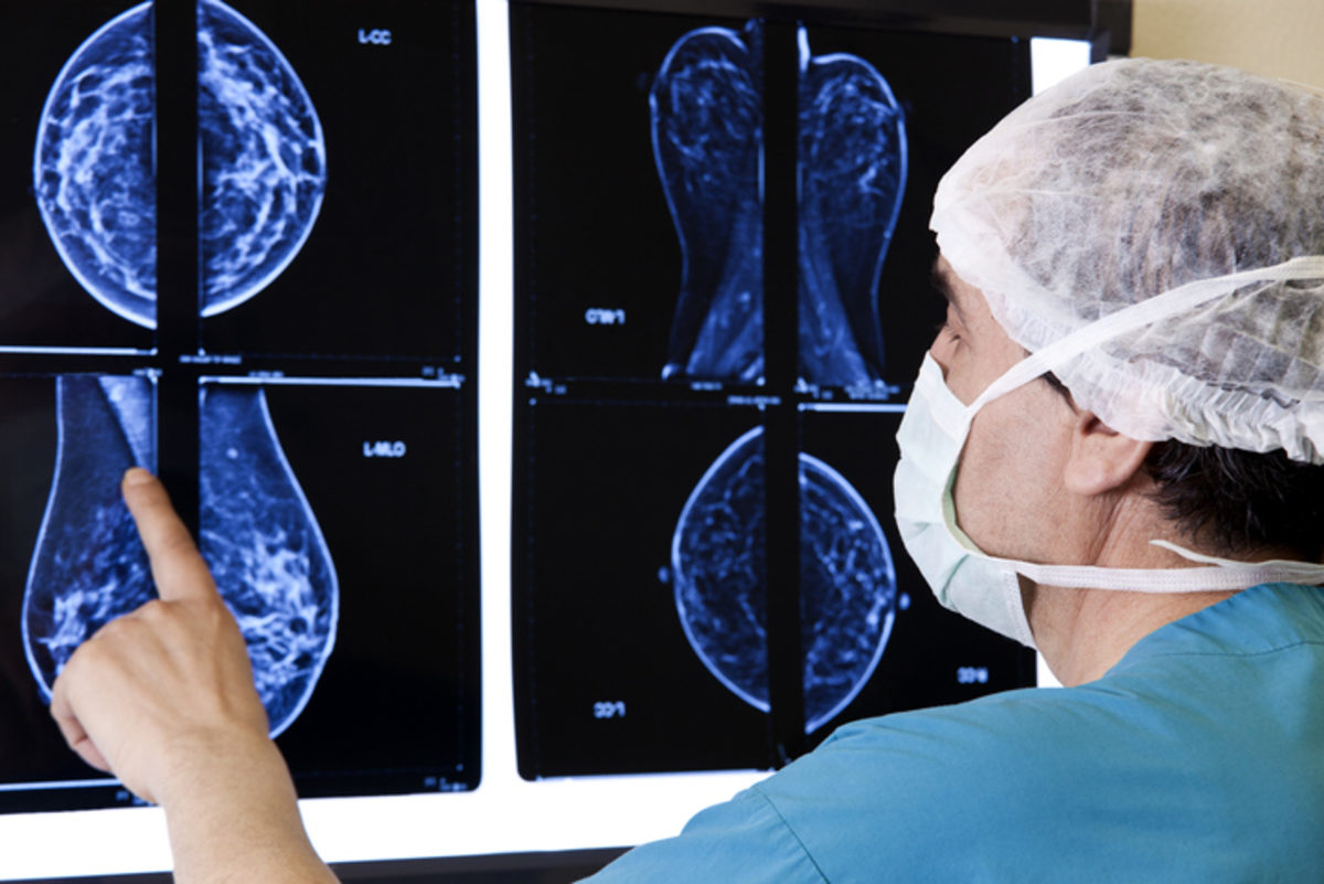 καρκίνος του μαστού