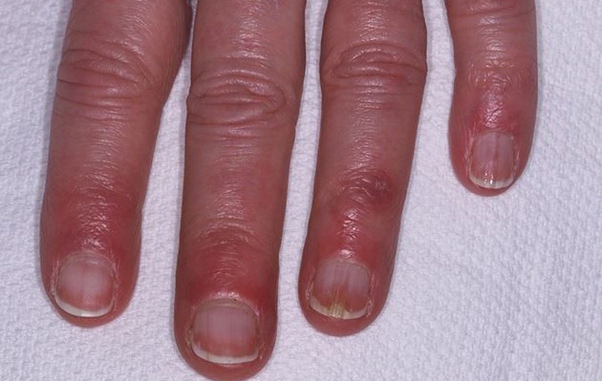 χιονίστρες