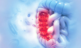 καρκίνος του παχέος εντέρου