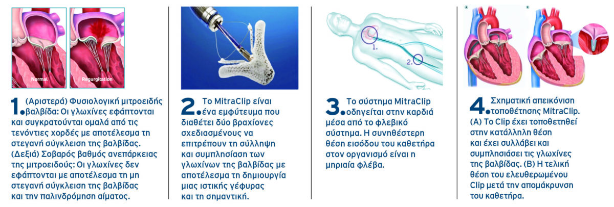 MitraClip