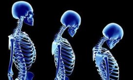 οστεοπόρωση