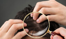 τριχόπτωση