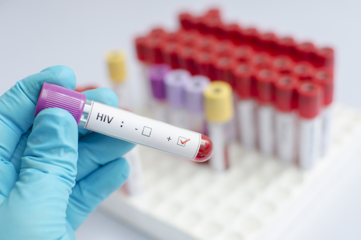 HIV-1 AIDS
