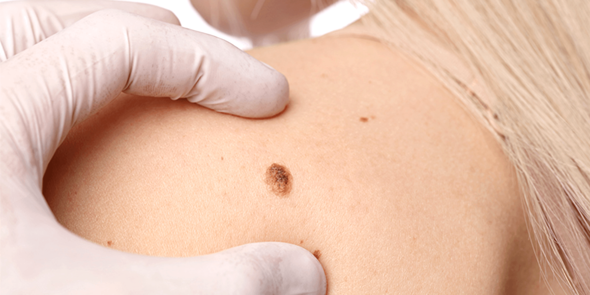 ανοσοθεραπεία