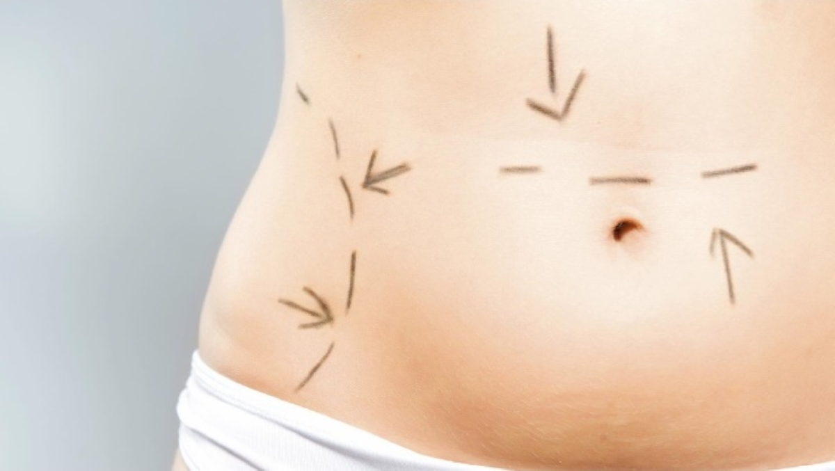 λιποαναρρόφηση