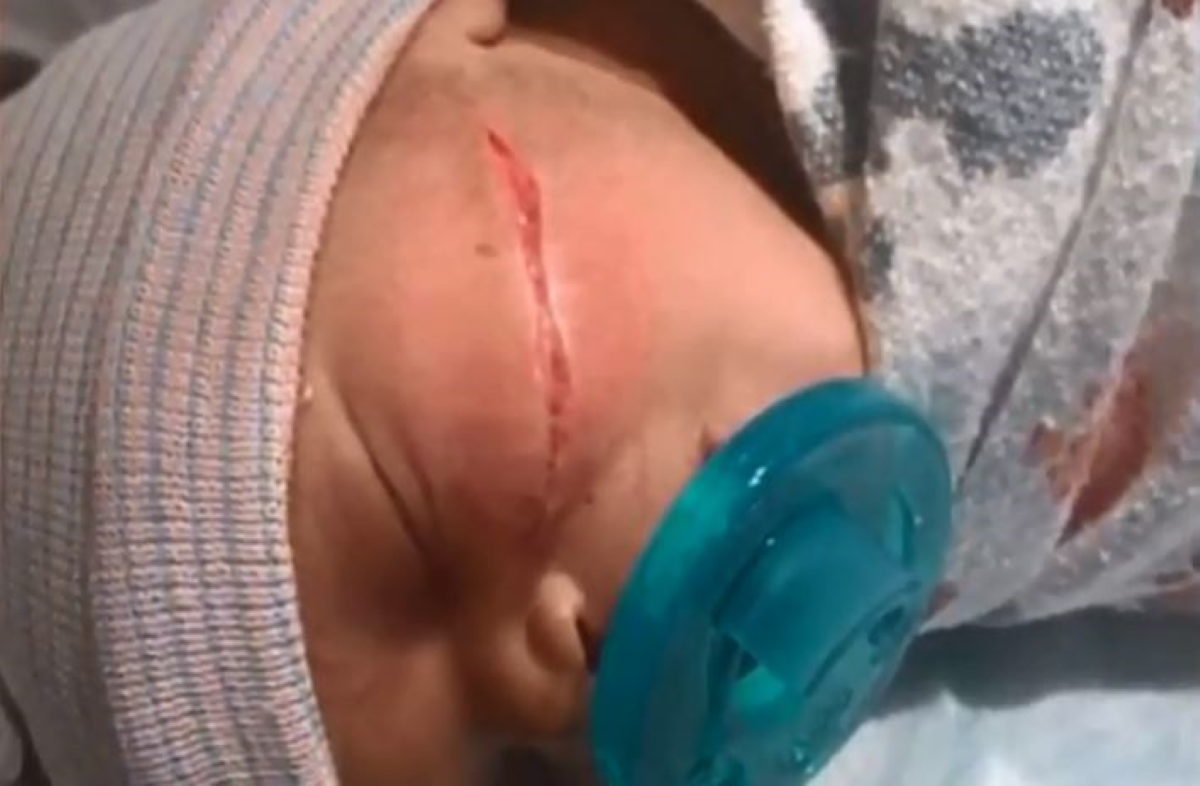 καισαρική τομή