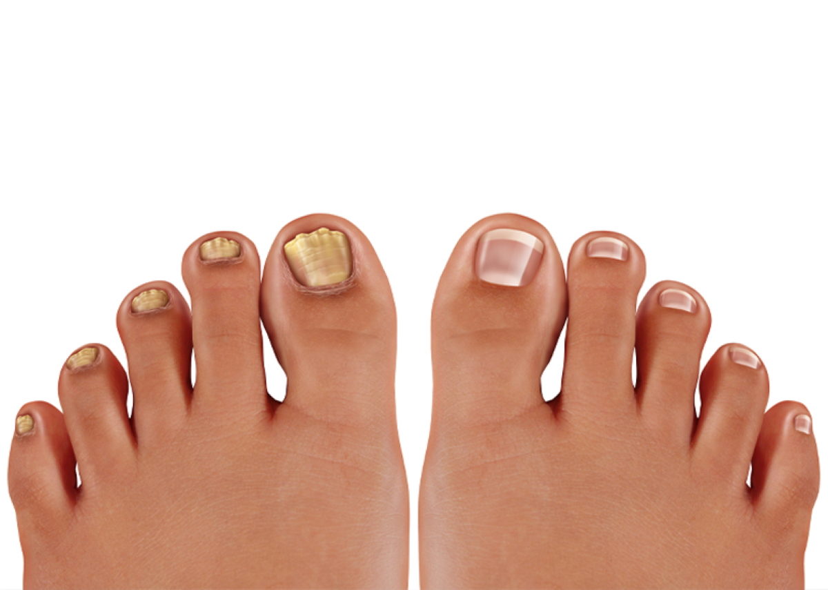 ονυχομυκητίαση