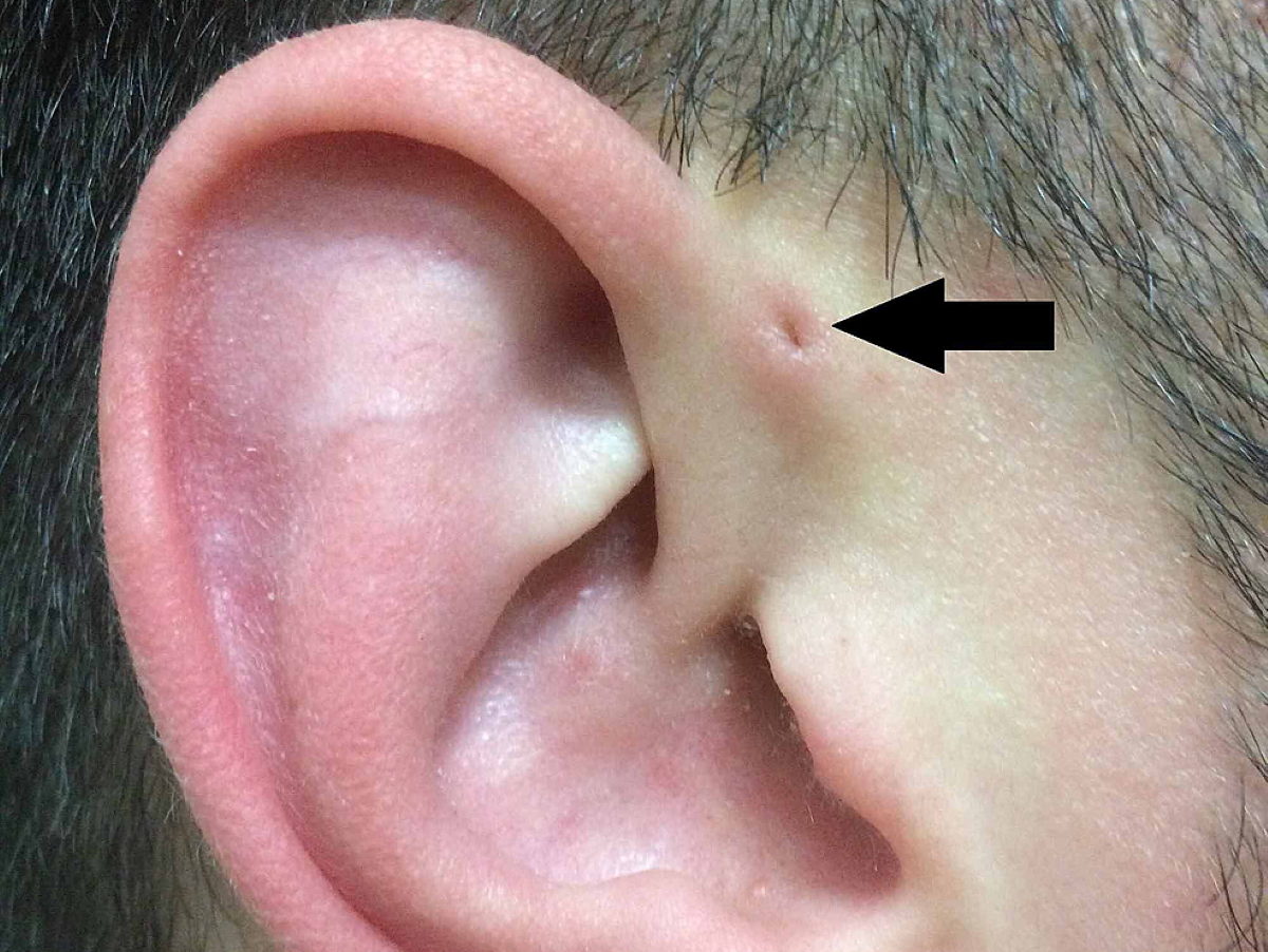 προαυλικός κολπίσκος