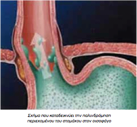 διαφραγματοκήλη
