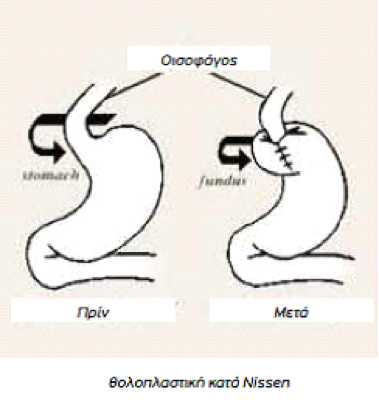 διαφραγματοκήλη