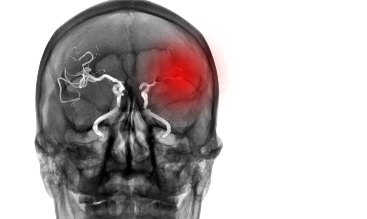 εγκεφαλικό