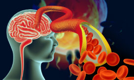 εγκεφαλική φλεβοθρόμβωση