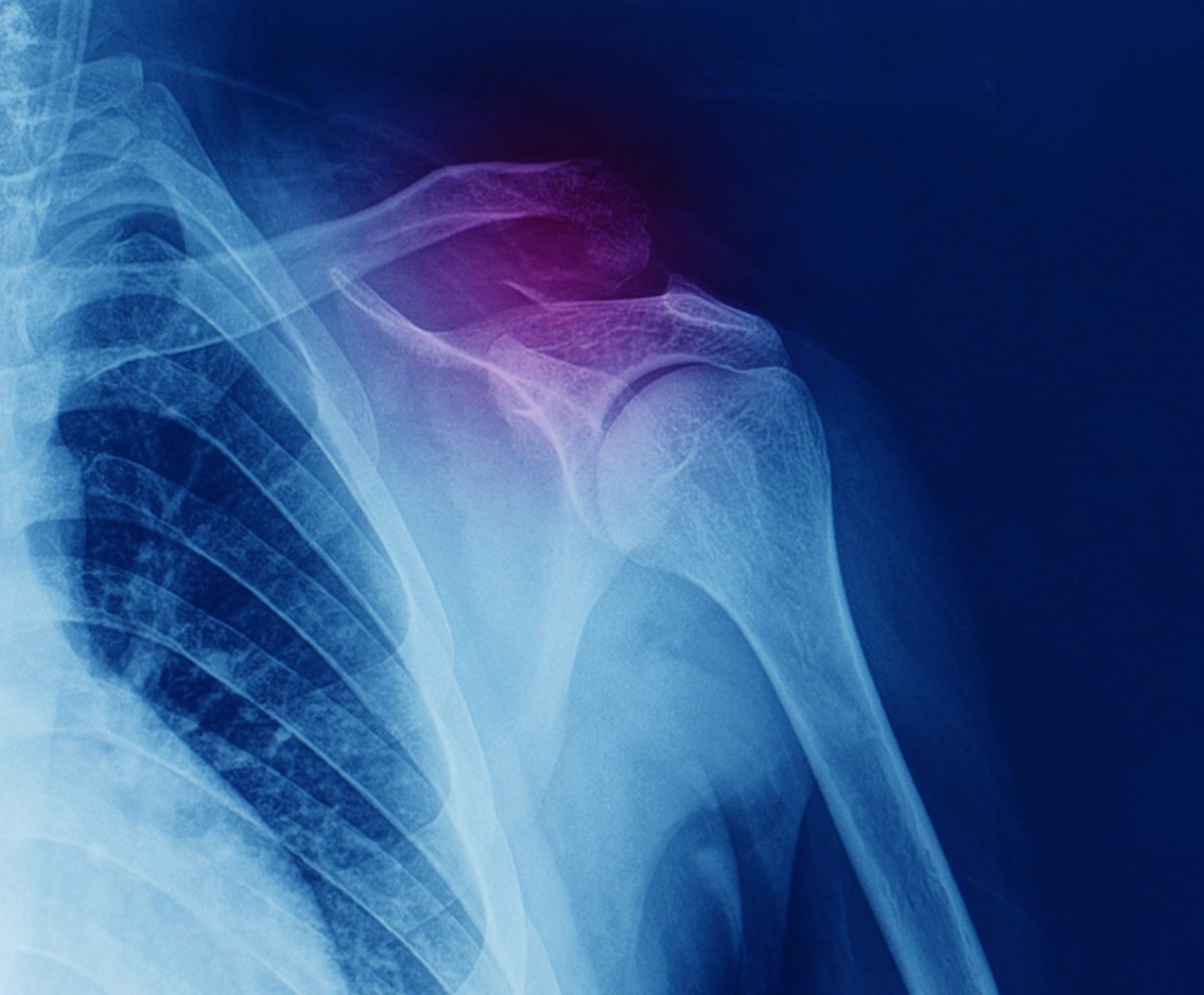 οστεοπορωτικά κατάγματα