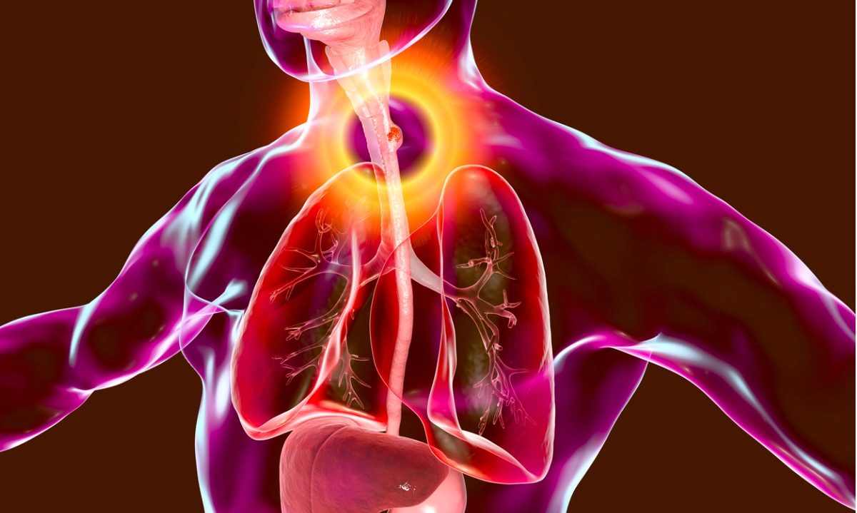 καρκίνος οισοφάγου