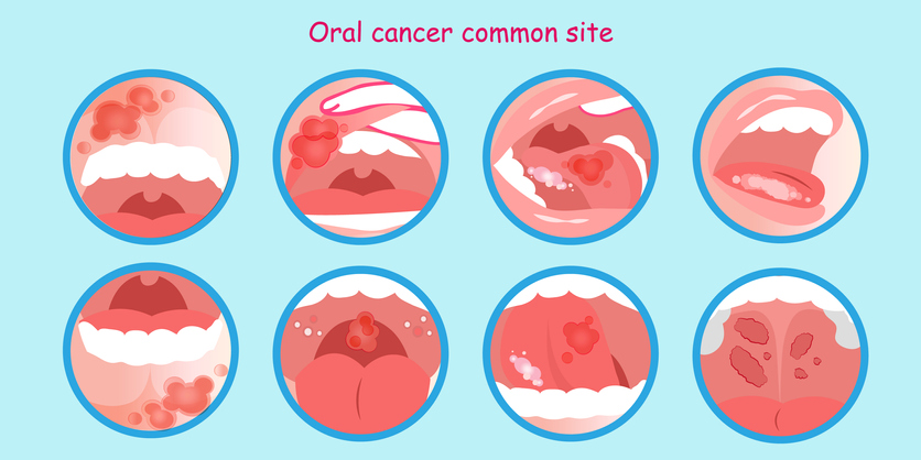 καρκίνος στο στόμα