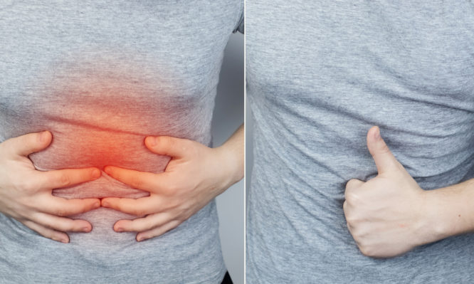 νόσος του Crohn