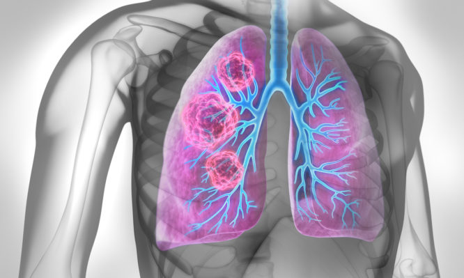 καρκίνος του πνεύμονα