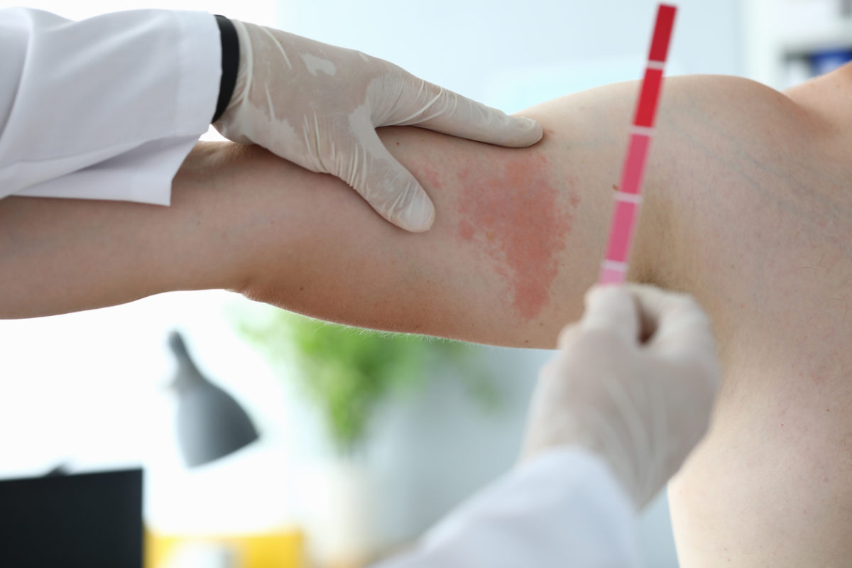 λιποειδική νεκροβίωση