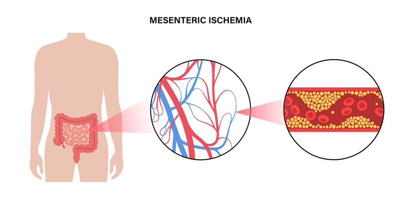 μεσεντέρια ισχαιμία
