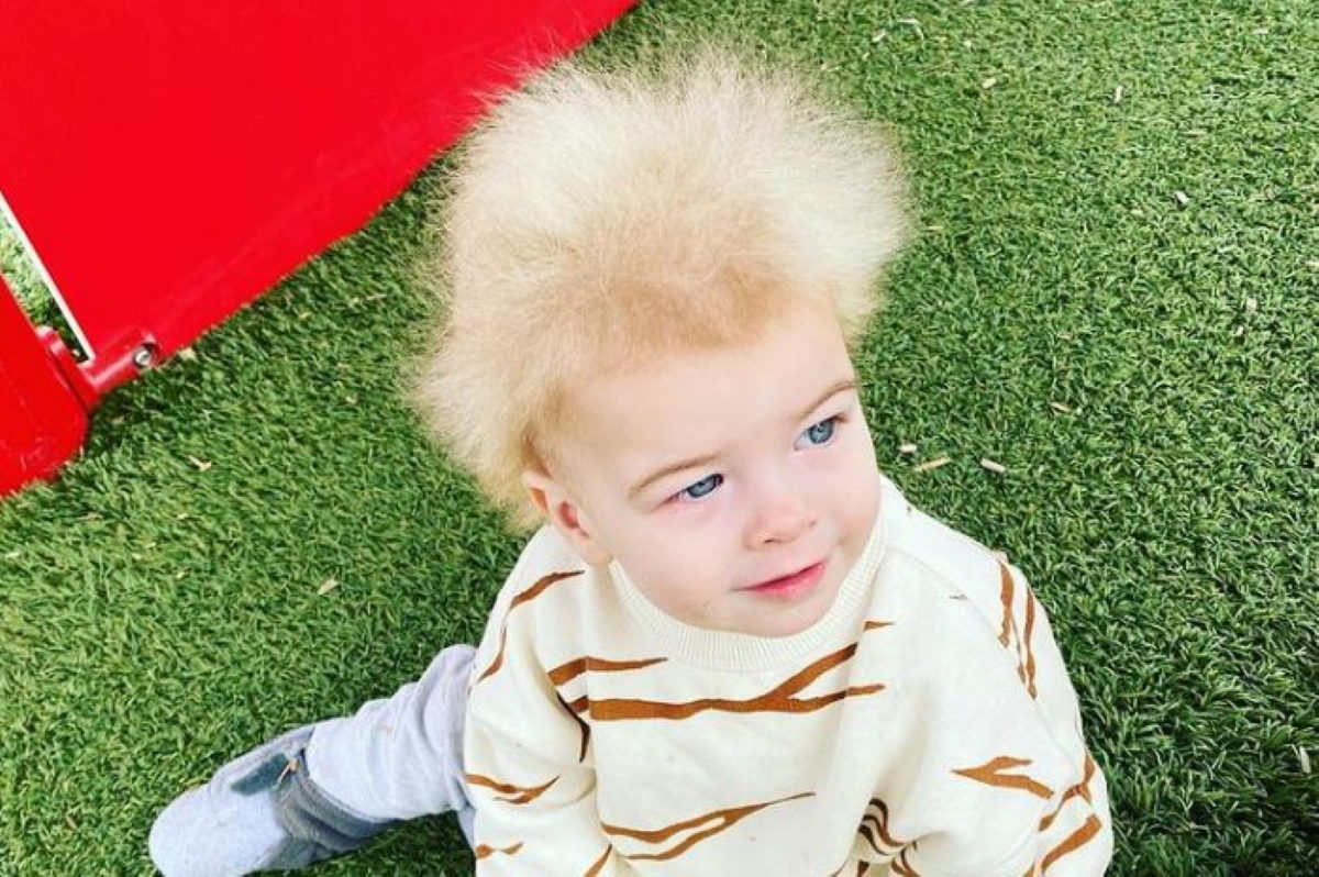 Σύνδρομο Αχτένιστων Μαλλιών