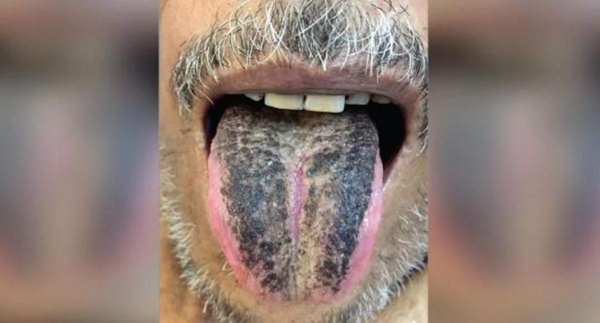 τριχωτή γλώσσα