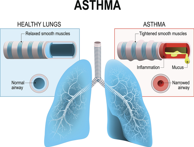 άσθμα