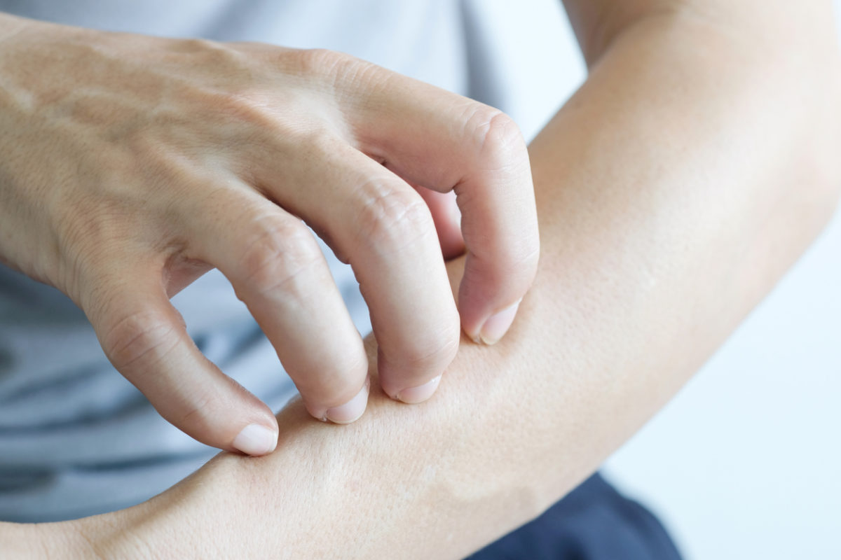 σπυράκια από τον ήλιο