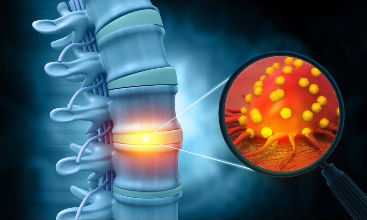 πολλαπλό μυέλωμα