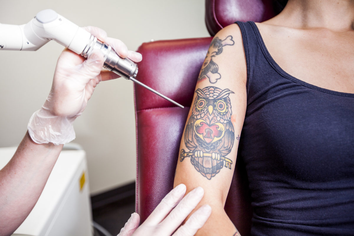 αφαίρεση τατουάζ με λέιζερ
