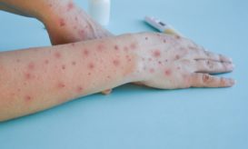 ευλογιά των πιθήκων