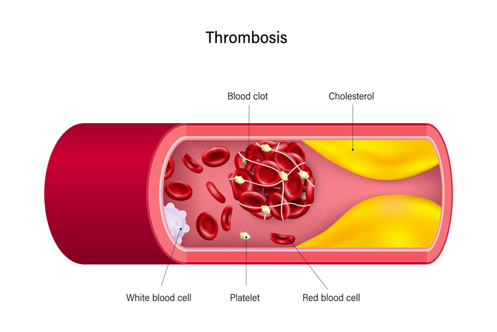 Συμπτώματα θρόμβωσης: Πώς θα καταλάβετε αν δημιουργείται θρόμβος αίματος