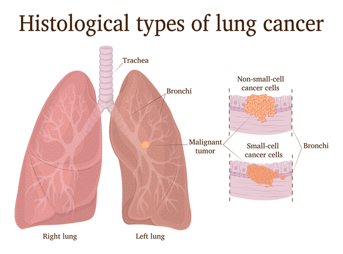μικροκυτταρικός καρκίνος του πνεύμονα