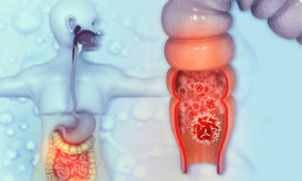 καρκίνος του παχέος εντέρου