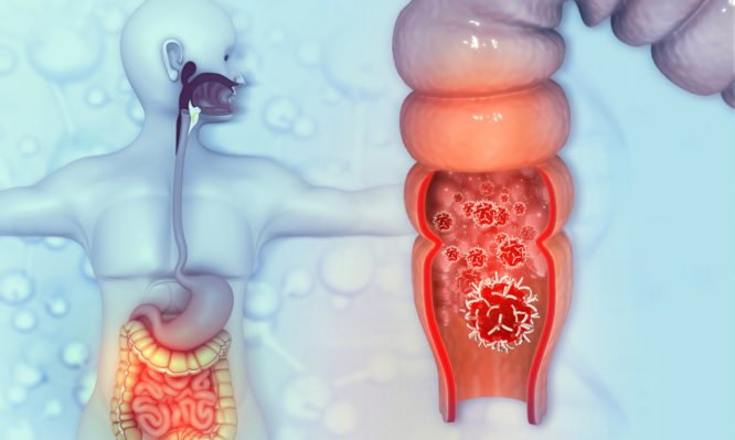 καρκίνος του παχέος εντέρου