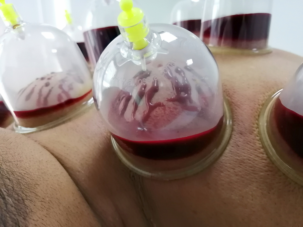 έρπης ζωστήρας