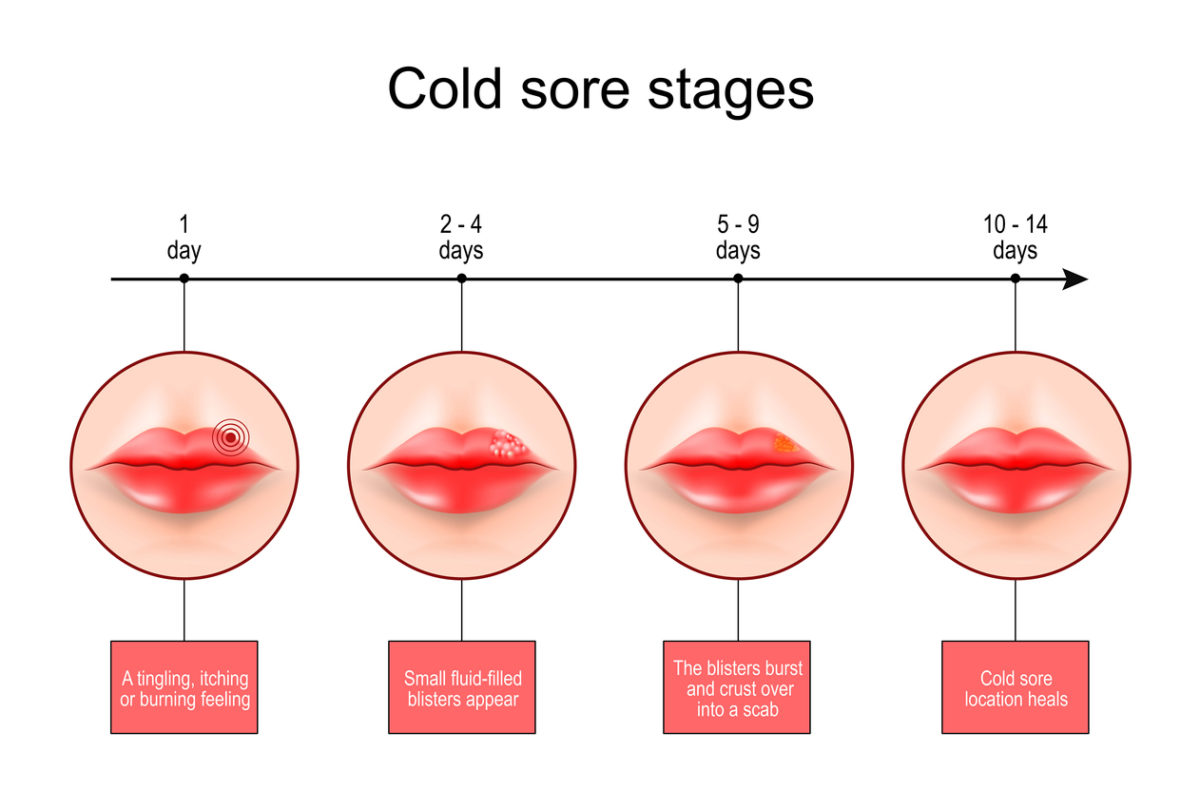 επιχείλιος έρπης