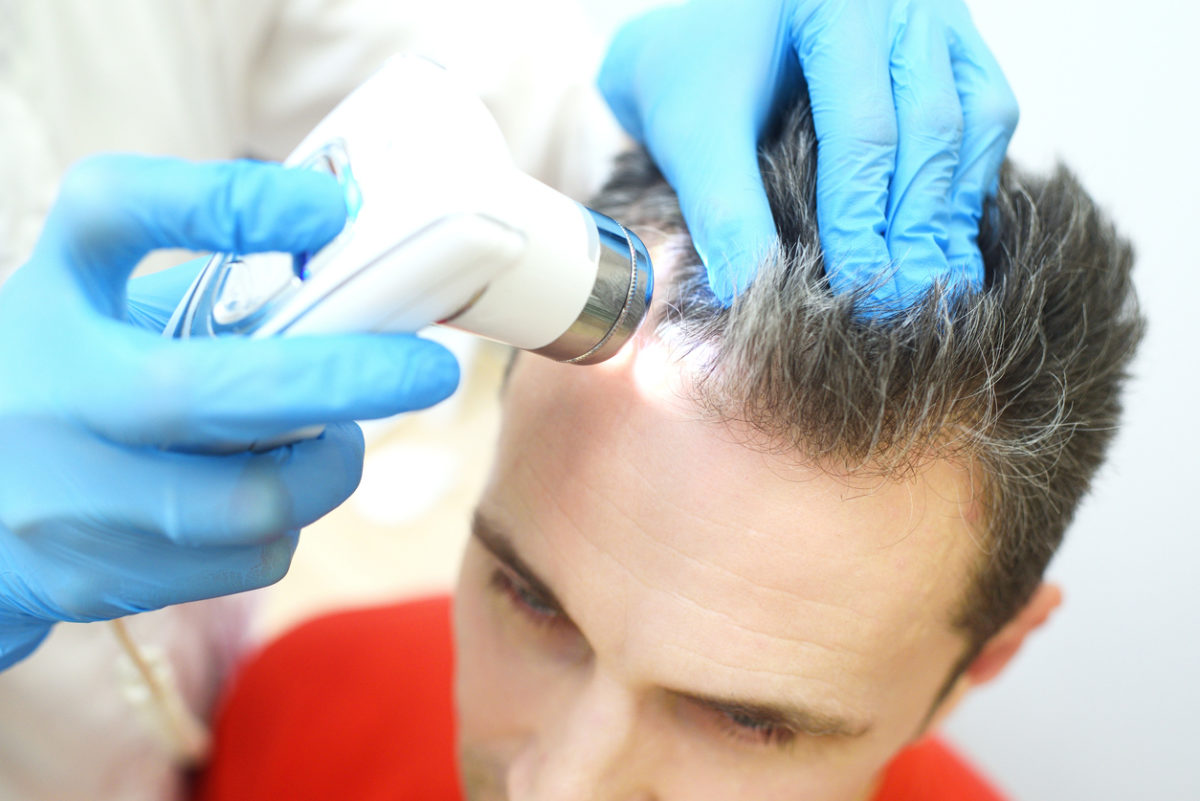 μεταμόσχευση μαλλιών