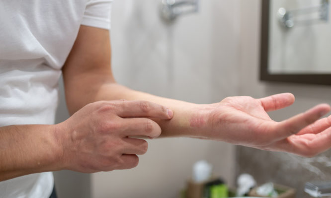 ατοπική δερματίτιδα