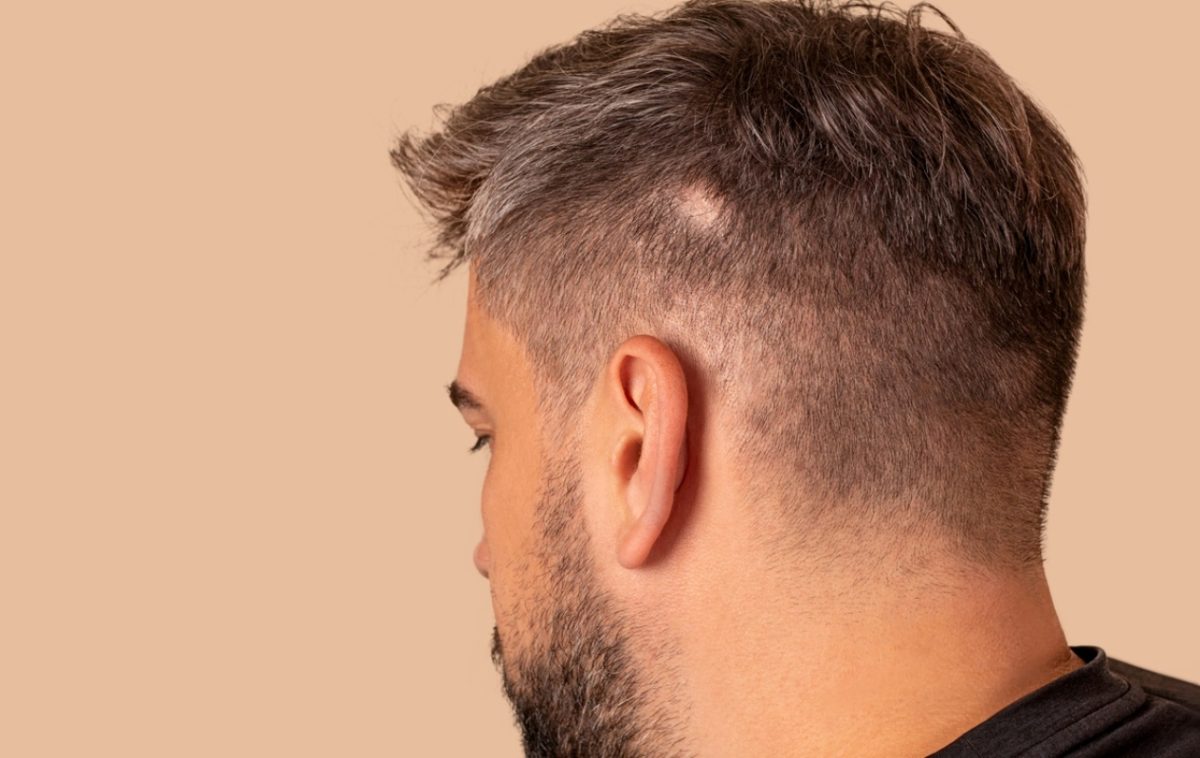 γυροειδής αλωπεκία