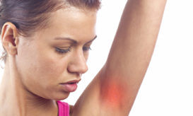 ιδρωταδενίτιδα