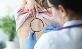 σκληροδερμία