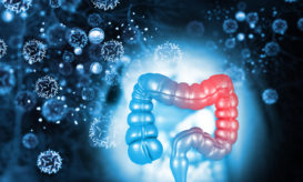 καρκίνος παχέος εντέρου