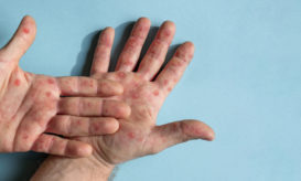 ευλογιά των πιθήκων