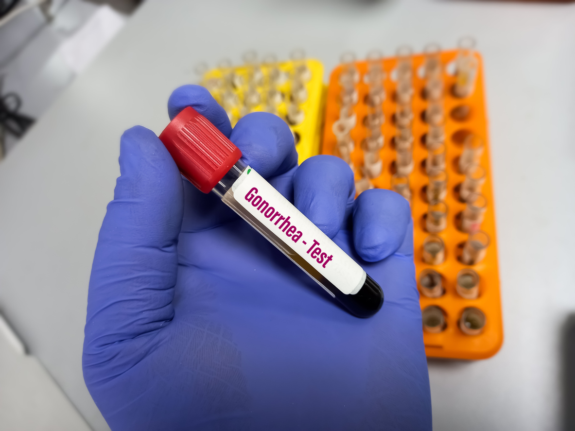 τεστ για γονόρροια